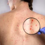 Sífilis continua em ritmo acelerado de crescimento no país